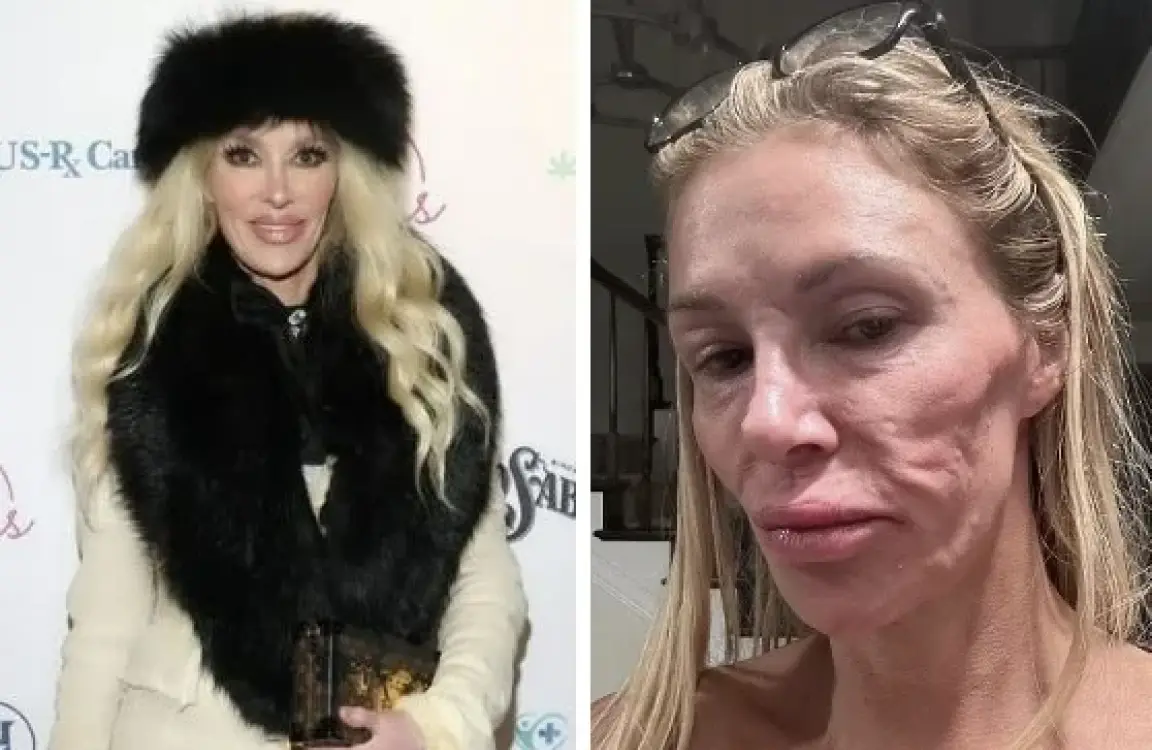 “Facial Deformation Attributed to Parasites” — After Spending KRW 200 Million, an 18-Year-Old Breast Implant Found to Be the Real Cause