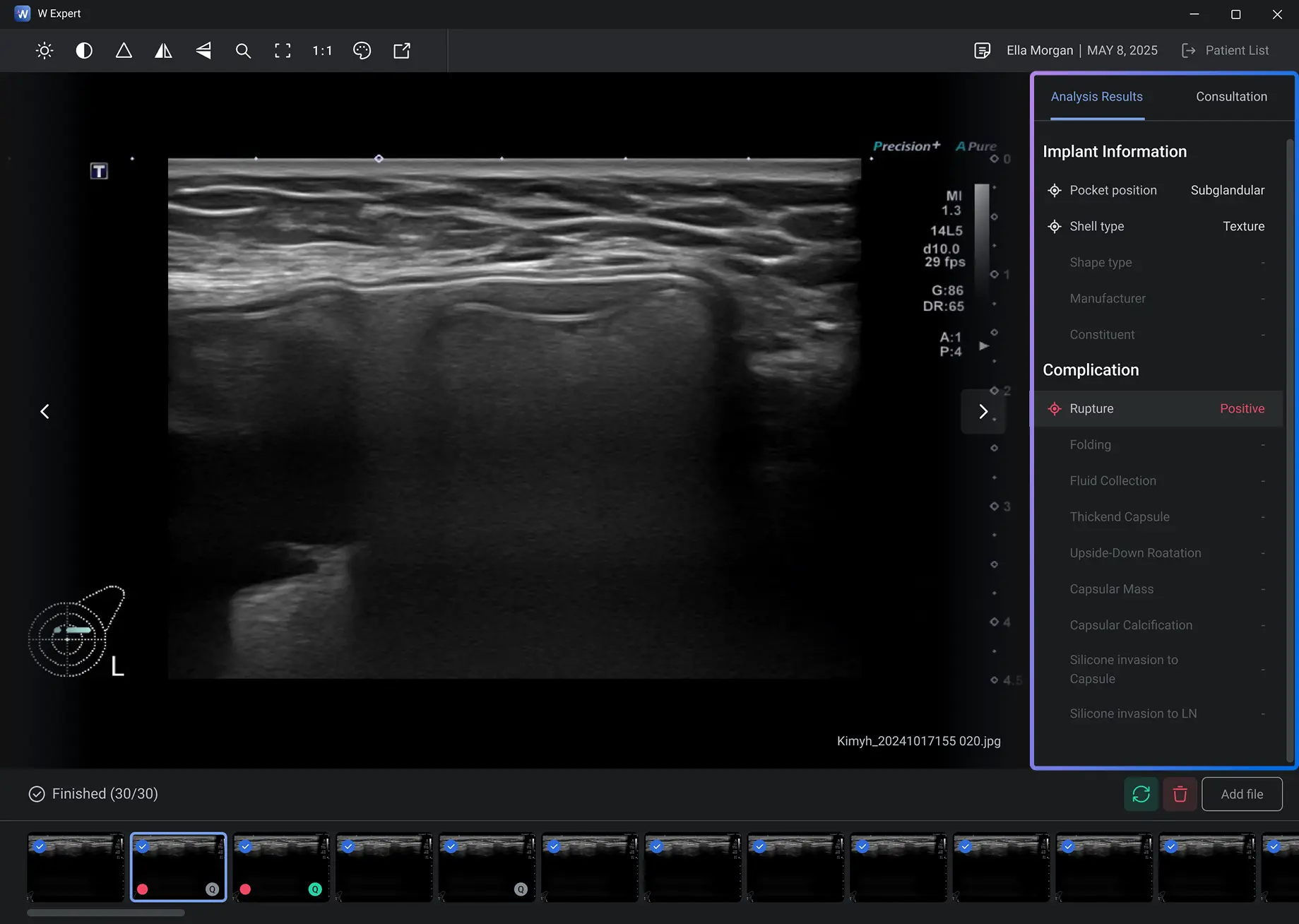 Implant Information Analysis
